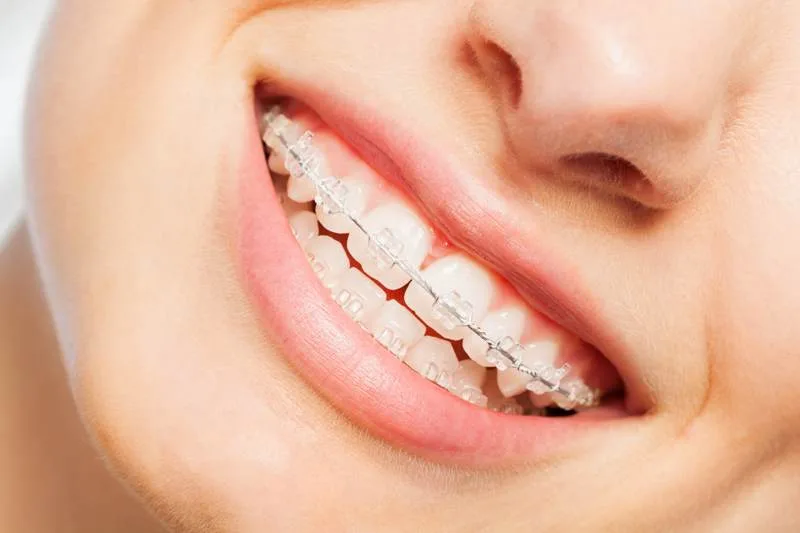 Brackets convencionales y estéticos Brackets convencionales y estéticos