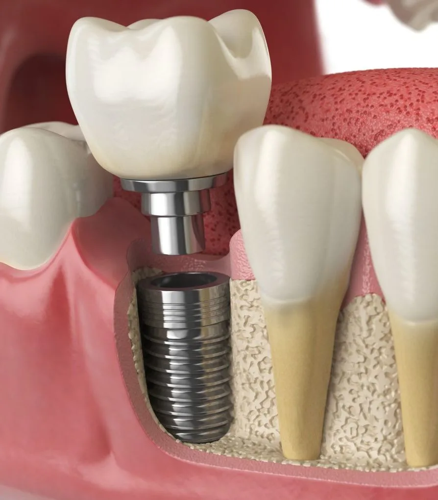 anatomy-of-healthy-teeth-and-tooth-dental-implant--P5PWYZQ