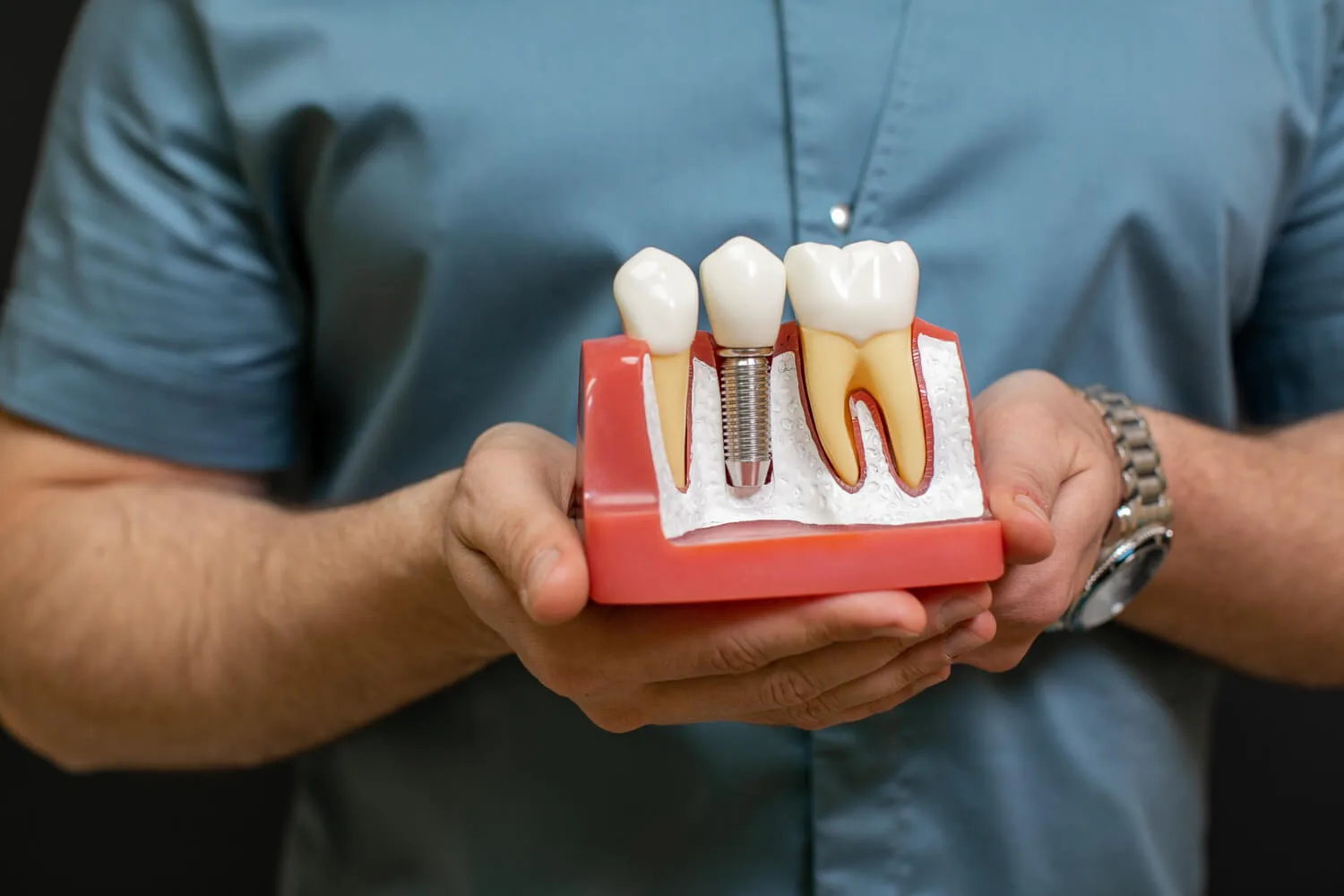 Implantes Dentales (1)