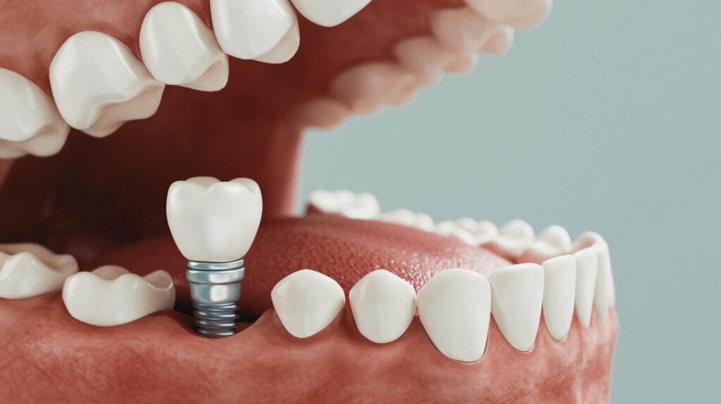 que son los implantes dentales