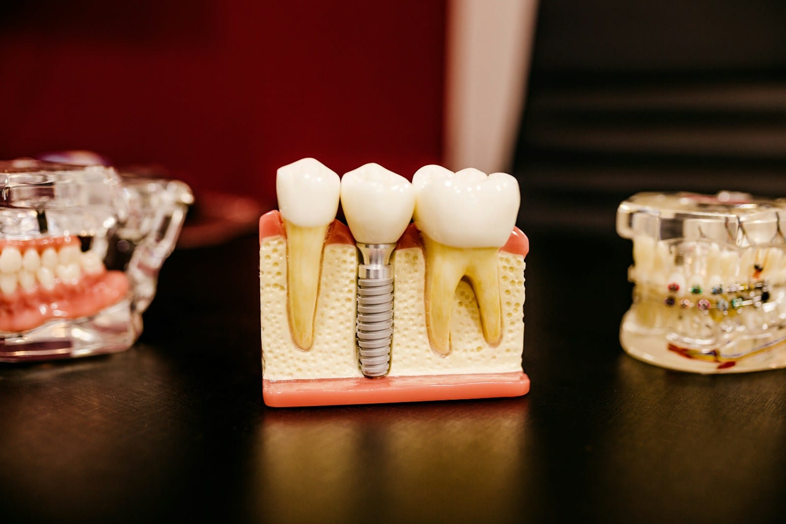 Implantes dentales en Madrid Implantes dentales en Madrid