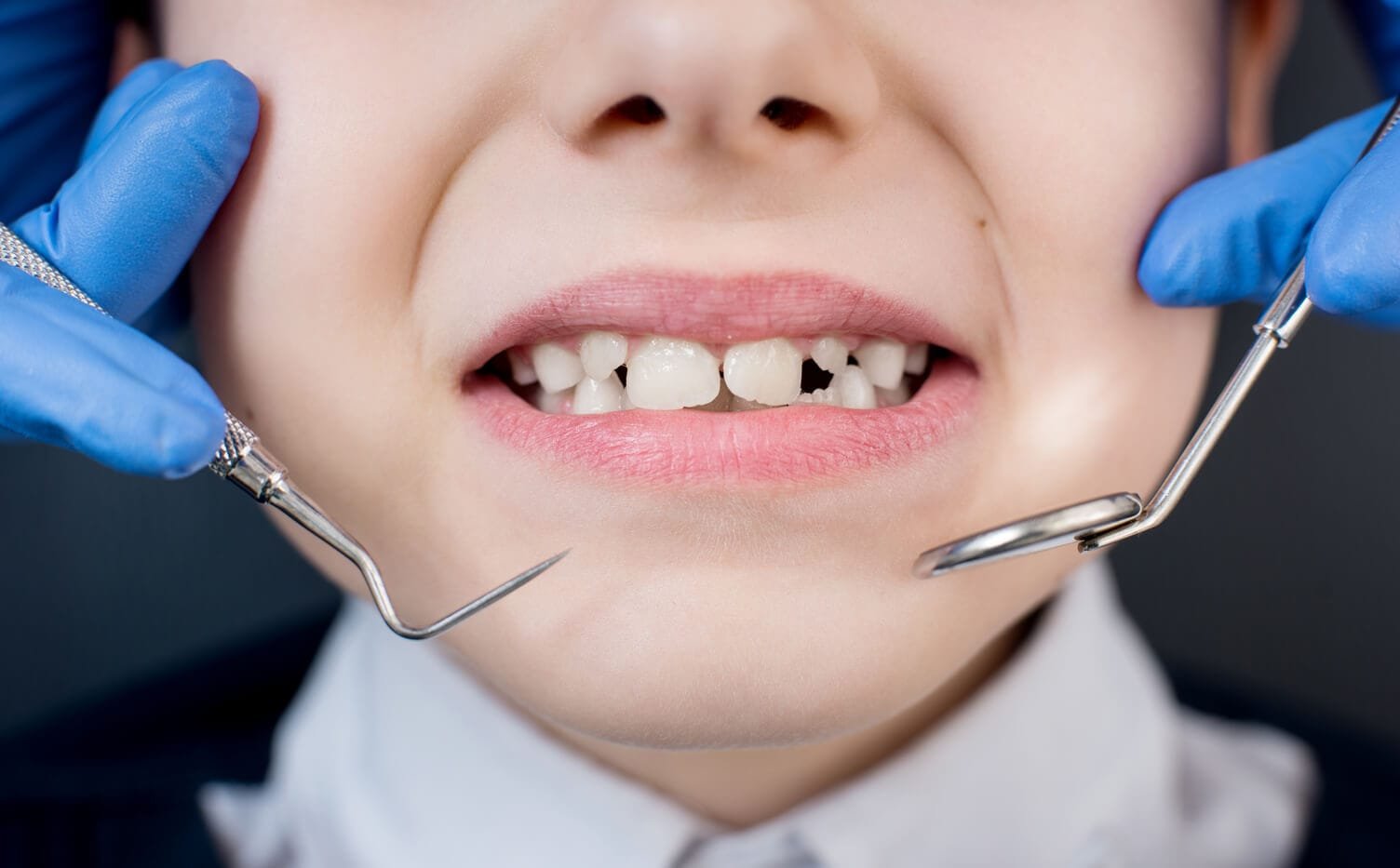 Ortodoncia infantil preventiva (Ortopedia)