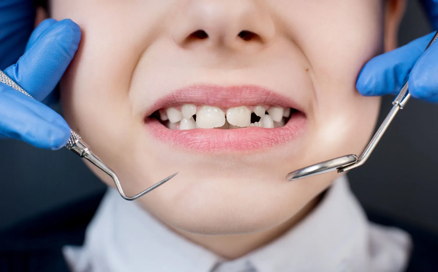 Ortodoncia infantil preventiva (Ortopedia)