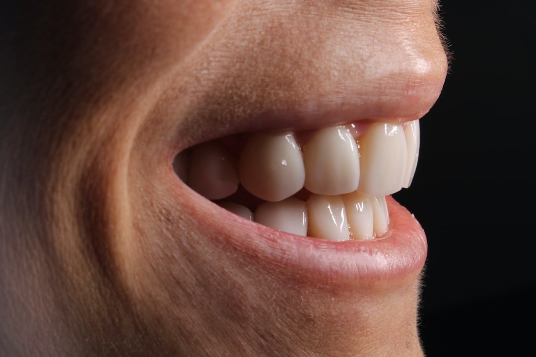 Blanqueamiento dental profesional